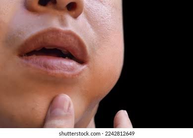 പടർന്നു പിടിച്ച് മുണ്ടി നീര് : ജാഗ്രത നിർദ്ദേശവുമായി ആരോഗ്യ വകുപ്പ്