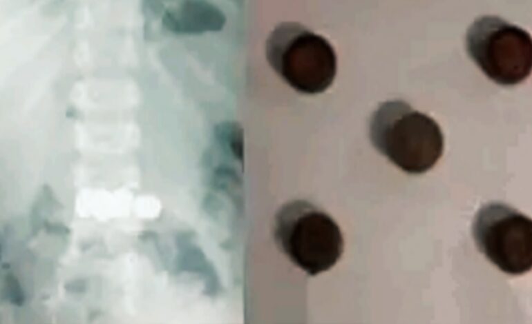 രണ്ടുവയസുകാരന്‍ അഞ്ച് കോയിന്‍ ബാറ്ററികള്‍ വിഴുങ്ങി; മണിക്കൂറുകള്‍ നീണ്ട എന്‍ഡോസ്‌കോപ്പിയിലൂടെ പുറത്തെടുത്തു