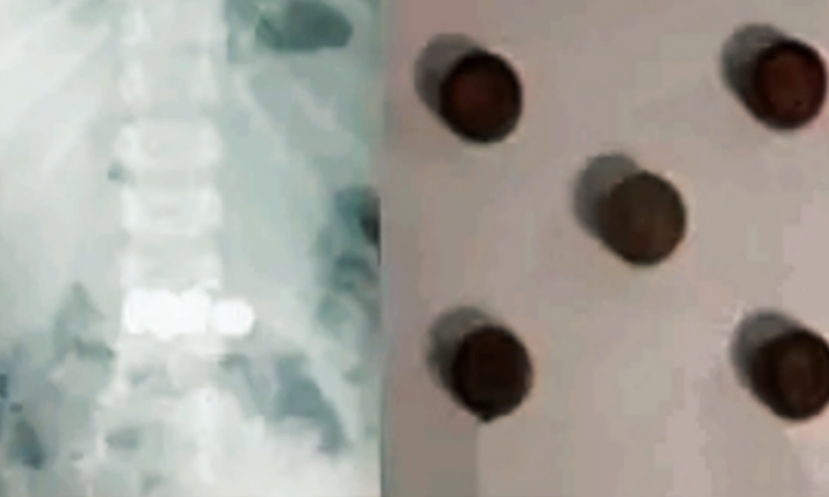 രണ്ടുവയസുകാരന്‍ അഞ്ച് കോയിന്‍ ബാറ്ററികള്‍ വിഴുങ്ങി; മണിക്കൂറുകള്‍ നീണ്ട എന്‍ഡോസ്‌കോപ്പിയിലൂടെ പുറത്തെടുത്തു