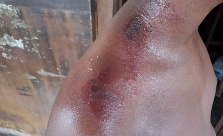 കൊടുംചൂടിൽ 10 വയസുകാരന് സൂര്യാഘാതം