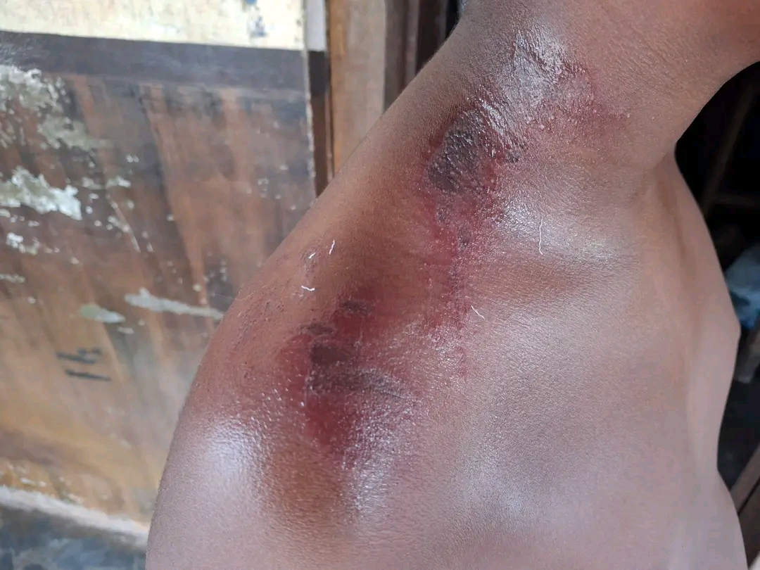 കൊടുംചൂടിൽ 10 വയസുകാരന് സൂര്യാഘാതം